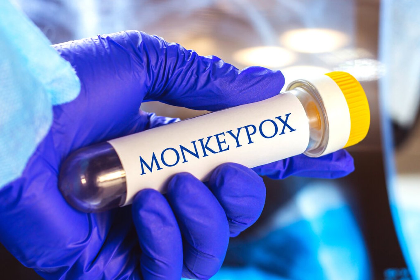 What you need to know about Monkeypox today